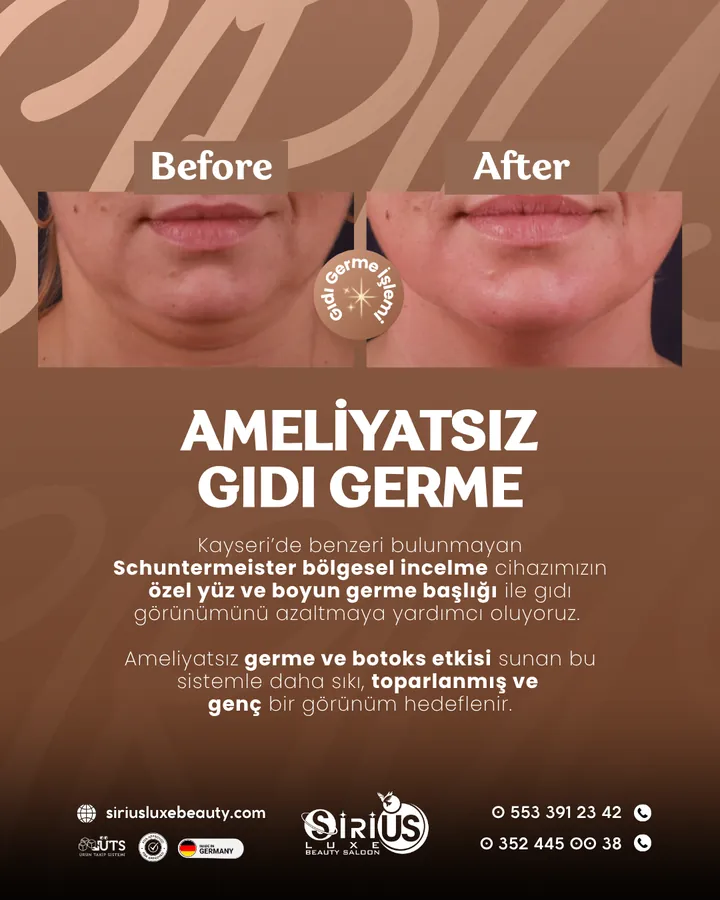 Schuntermeister ile Ameliyatsız Gıdı Germe uygulaması